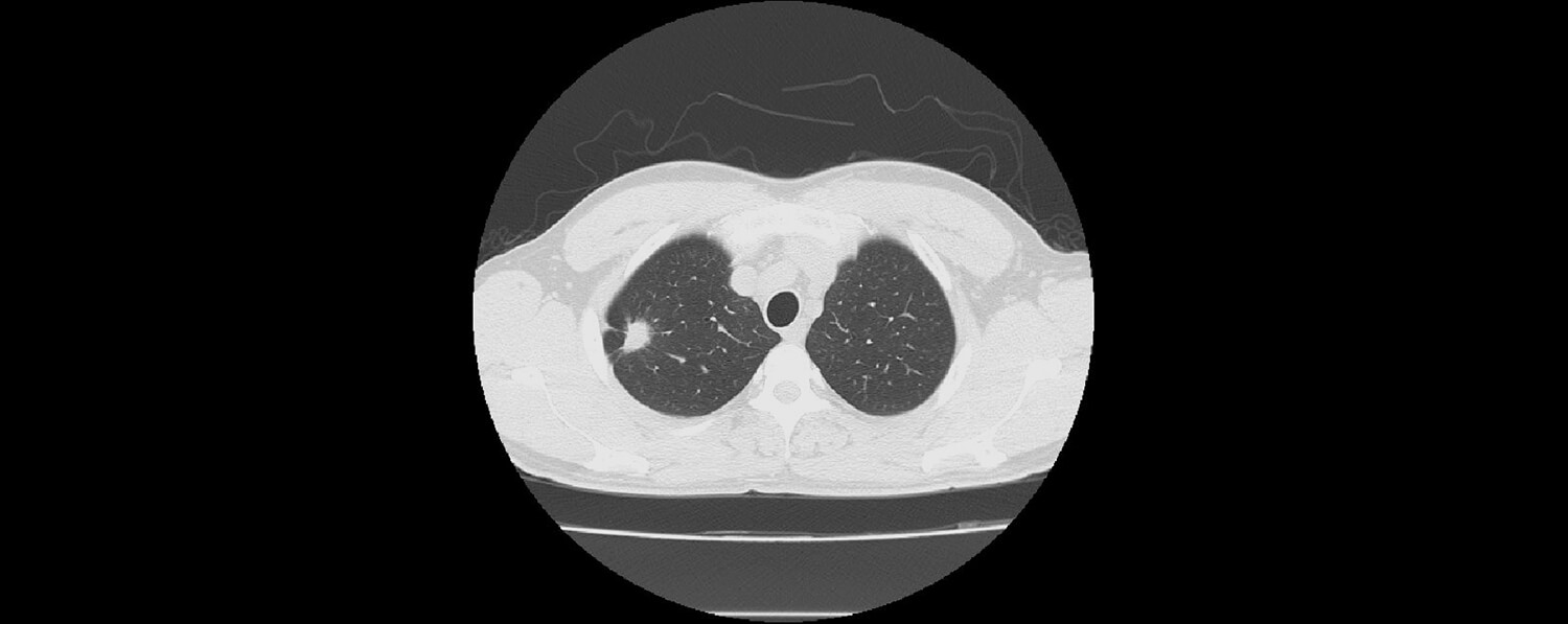肺ドック画像1